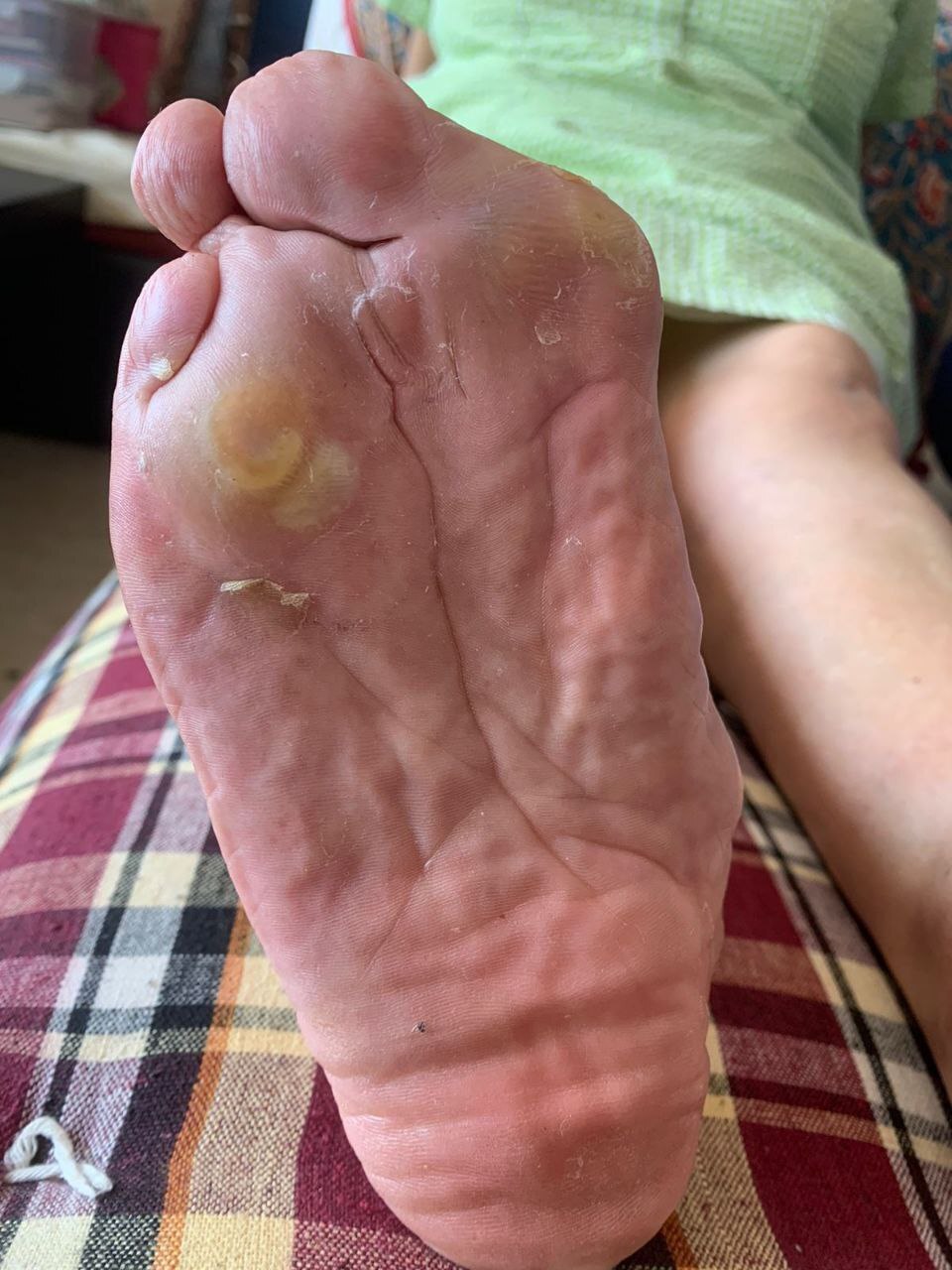 Toe Bunion